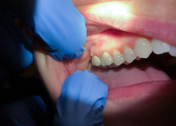 Best Emergency Tooth Extraction in South Elgin, IL